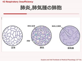 43 Respiratory Insufficiency
Guyton and Hall Textbook of Medical Physiology 13th Ed.
肺炎,肺気腫の肺胞
正常 肺炎 肺気腫
浮腫
液体と血球 融合した肺胞
 