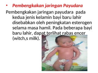 • Pembengkakan jaringan Payudara
Pembengkakan jaringan payudara pada
kedua jenis kelamin bayi baru lahir
disebabkan oleh peningkatan esterogen
selama masa hamil. Pada beberapa bayi
baru lahir, dapat terlihat rabas encer
(witch,s milk).
 
