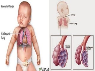 fisiologi bayi baru lahir dalam kebidanan