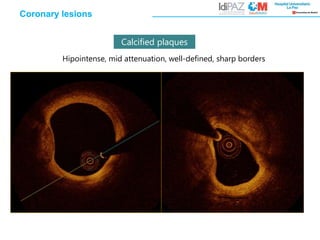 Coronary lesions
Calcified plaques
Hipointense, mid attenuation, well-defined, sharp borders
 