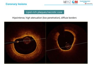 Hipointense, high atenuation (low penetration), diffuse borders
Lipid-rich plaques/necrotic core
Coronary lesions
 