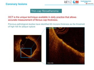 Thin-cap fibroatheroma
OCT is the unique technique available in daily practice that allows
accurate measurement of fibrous cap thickness.
Previous pathological studies have identified 65 microns thickness as the threshold
of high risk for plaque rupture
Coronary lesions
 