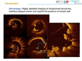 Advantage: Highly detailed imaging of intraluminal structures,
interface plaque-lumen and superficial portions of vessel wall
Introduction
 