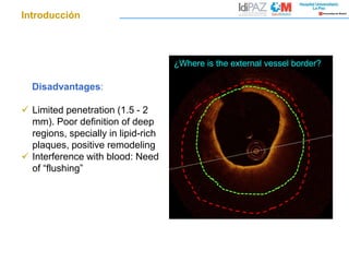 ¿Where is the external vessel border?
Disadvantages:
 Limited penetration (1.5 - 2
mm). Poor definition of deep
regions, specially in lipid-rich
plaques, positive remodeling
 Interference with blood: Need
of “flushing”
Introducción
 