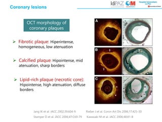 Jang IK et al. JACC 2002;39:604-9 Rieber J et al. Coron Art Dis 2006;17:425-30
Stamper D et al. JACC 2006;47:C69-79 Kawasaki M et al. JACC 2006;48:81-8
 Fibrotic plaque: Hiperintense,
homogeneous, low atenuation
 Lipid-rich plaque (necrotic core):
Hipointense, high atenuation, diffuse
borders
 Calcified plaque: Hipointense, mid
atenuation, sharp borders
Coronary lesions
OCT morphology of
coronary plaques
 