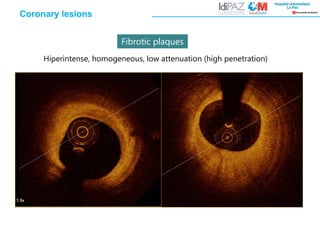 Fibrotic plaques
Coronary lesions
Hiperintense, homogeneous, low attenuation (high penetration)
 