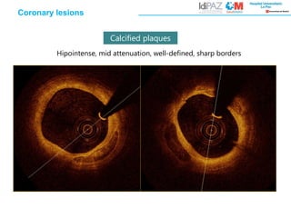 Calcified plaques
Hipointense, mid attenuation, well-defined, sharp borders
Coronary lesions
 