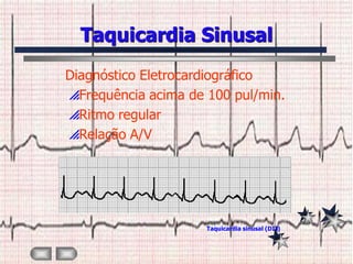 Taquicardia Sinusal
Diagnóstico Eletrocardiográfico
Frequência acima de 100 pul/min.
Ritmo regular
Relação A/V




                     Taquicardia sinusal (DII)
 