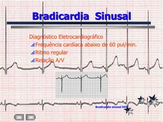 Bradicardia Sinusal
Diagnóstico Eletrocardiográfico
 Frequência cardíaca abaixo de 60 pul/min.
 Ritmo regular
 Relação A/V




                          Bradicardia sinusal DII
 