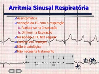 Arritmia Sinusal Respiratória
  Assintomática
  Variação da FC com a respiração
    Acelera-se na Inspiração
    Diminui na Expiração
  Na apnéia a FC fica regular
  Comum em crianças
  Não é patológica
  Não necessita tratamento
 