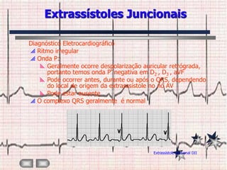 Extrassístoles Juncionais

Diagnóstico Eletrocardiográfico
 Ritmo irregular
 Onda P:
     Geralmente ocorre despolarização auricular retrógrada,
      portanto temos onda P’ negativa em D2 , D3 , aVF
     Pode ocorrer antes, durante ou após o QRS, dependendo
      do local de origem da extrasssístole no nó AV
     Pode estar ausente
 O complexo QRS geralmente é normal




                                          Extrassístole juncional DII
 