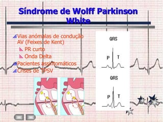 Síndrome de Wolff Parkinson
            White
 Vias anómalas de condução
  AV (Feixes de Kent)
   PR curto
   Onda Delta
 Pacientes assintomáticos
 Crises de TPSV
 