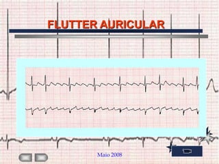 FLUTTER AURICULAR




       Maio 2008
 