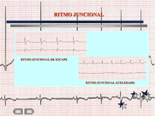 RITMO JUNCIONAL




RITMO JUNCIONAL DE ESCAPE




                            RITMO JUNCIONAL ACELERADO
 