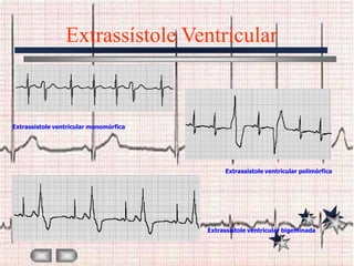 Extrassístole Ventricular



Extrassístole ventricular monomórfica




                                             Extrassístole ventricular polimórfica




                                        Extrassístole ventricular bigeminada
 