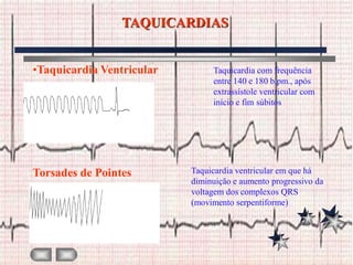 TAQUICARDIAS


•Taquicardia Ventricular        Taquicardia com frequência
                                entre 140 e 180 b.pm., após
                                extrassístole ventricular com
                                início e fim súbitos




Torsades de Pointes        Taquicardia ventricular em que há
                           diminuição e aumento progressivo da
                           voltagem dos complexos QRS
                           (movimento serpentiforme)
 