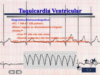 Taquicardia Ventricular
Diagnóstico Eletrocardiográfico
FC:  100 e 220 pul/min.
Ritmo: regular ou discretamente irregular

Ondas P :

    Com FC alta não são vistas

    Quando presentes não tem relação com o QRS

QRS: tem a mesma morfologia das extrassístoles ventriculares
 