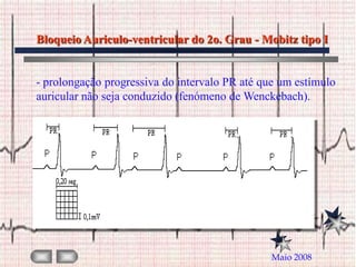 Bloqueio Auriculo-ventricular do 2o. Grau - Mobitz tipo I


- prolongação progressiva do intervalo PR até que um estímulo
auricular não seja conduzido (fenómeno de Wenckebach).




                                               Maio 2008
 