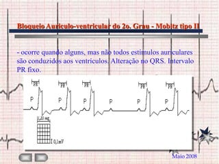 Bloqueio Auriculo-ventricular do 2o. Grau - Mobitz tipo II


- ocorre quando alguns, mas não todos estímulos auriculares
são conduzidos aos ventrículos. Alteração no QRS. Intervalo
PR fixo.




                                                   Maio 2008
 
