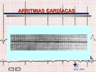 ARRITMIAS CARDÍACAS




                  Maio 2008
 