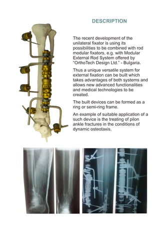 Hybrid External Fixator - Nestorov | PDF