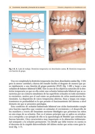Una vez completada la dentición temporaria ésta tiene desoclusión canina (fig. 1-6A)
pero la menor cantidad y dureza del esmalte facilita el desgaste de manera que pa-
sa rápidamente a una función de grupo posterior (FGP) (fig. 1-6B) y luego a una
oclusión de balance bilateral (OBB). Éste es uno de los objetivos naturales de la den-
tición temporaria ya que en ella existe una oclusión balanceada bilateral que se ca-
racteriza por un contacto simultáneo de las superficies oclusales en todo movimien-
to excéntrico, motivo por el cual existe un predominio de ciclos masticatorios ho-
rizontales. La disposición de raíces temporarias abiertas, finas y largas con empo-
tramientos en profundidad es lo que permite el funcionamiento del sistema a nivel
dentario sin que se presenten patologías.
Esta condición de oclusión balanceada bilateral con ciclos horizontales cumple
otra función específica que consiste en estimular el crecimiento y el desarrollo de
los maxilares a través del bruxismo nocturno fisiológico que presentan los niños
en esta etapa de su oclusión. Éste es el mismo principio que se aplica en ortodon-
cia u ortopedia y un ejemplo de ello es la aparatología de Bimbler que estimula las
fuerzas laterales. Otra característica muy importante es la alineación tridimensio-
nal semejante a la oclusión permanente. Un detalle que debe tenerse en cuenta es
el descenso de la cúspide distovestibular del último molar que actúa como guía la-
teral (fig. 1-7).
66 Crecimiento, desarrollo y formación de la oclusión Oclusión y diagnóstico en rehabilitación oral
Fig. 1-6. A. Lado de trabajo. Dentición temporaria con desoclusión canina. B. Dentición temporaria
con función de grupo.
A
B
 