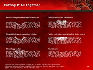 18
Putting It All Together
Reprinted with permission from Chandler WL. In: Spiess BD, et al, eds. Perioperative
Transfusion Medicine. 2nd ed. Philadelphia, PA: Lippincott Williams & Wilkins; 2005:chap 7.
©2005 Lippincott Williams & Wilkins http://lww.com
Wound: collagen and tissue factor exposure Fibrin formation, clot stabilization
Platelet binding and coagulation initiation Platelet contraction, wound healing, fibrin removal
Platelet aggregation Wound healed
 