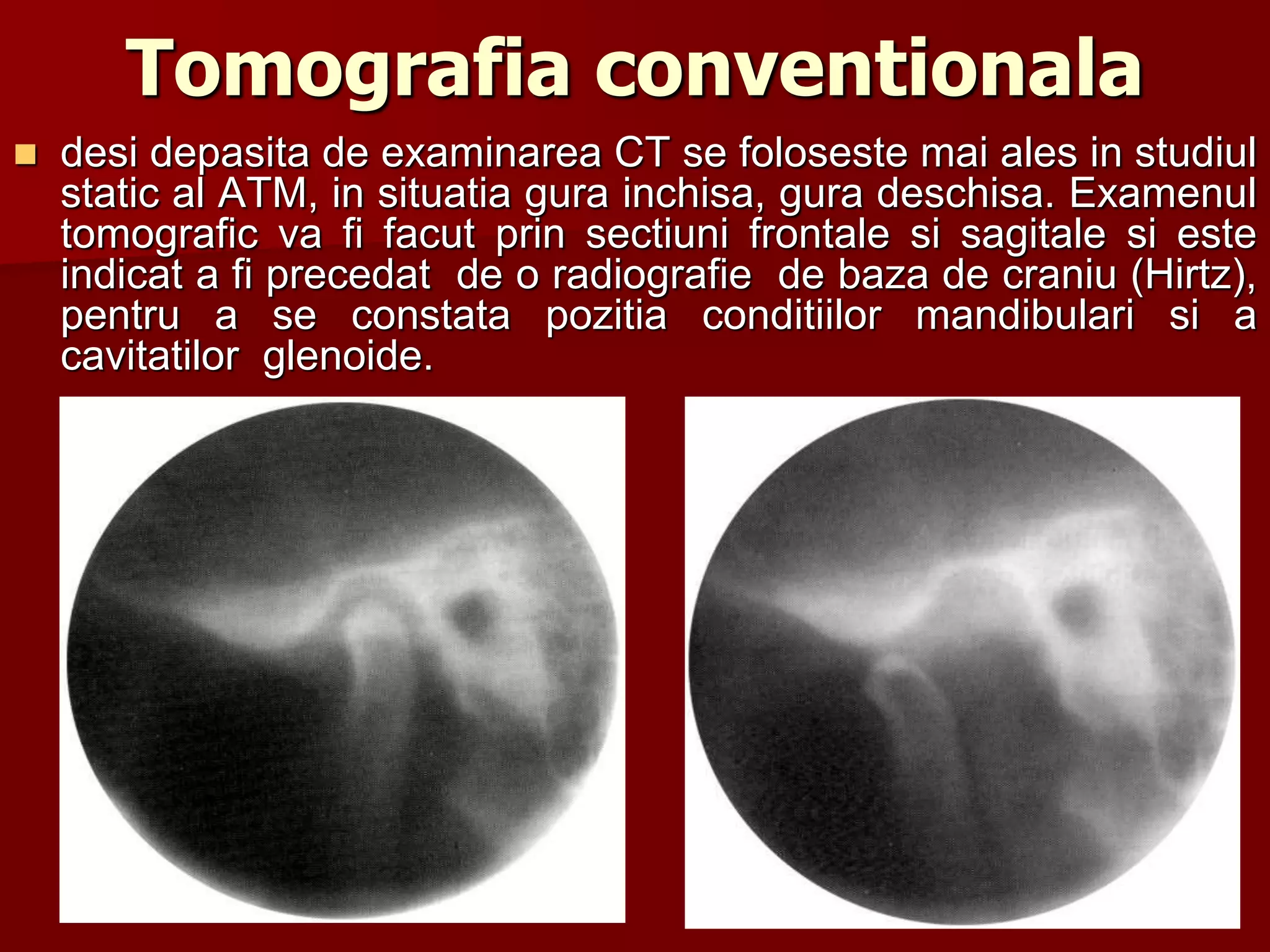Tomografia conventionala
 desi depasita de examinarea CT se foloseste mai ales in studiul
static al ATM, in situatia gura inchisa, gura deschisa. Examenul
tomografic va fi facut prin sectiuni frontale si sagitale si este
indicat a fi precedat de o radiografie de baza de craniu (Hirtz),
pentru a se constata pozitia conditiilor mandibulari si a
cavitatilor glenoide.
 