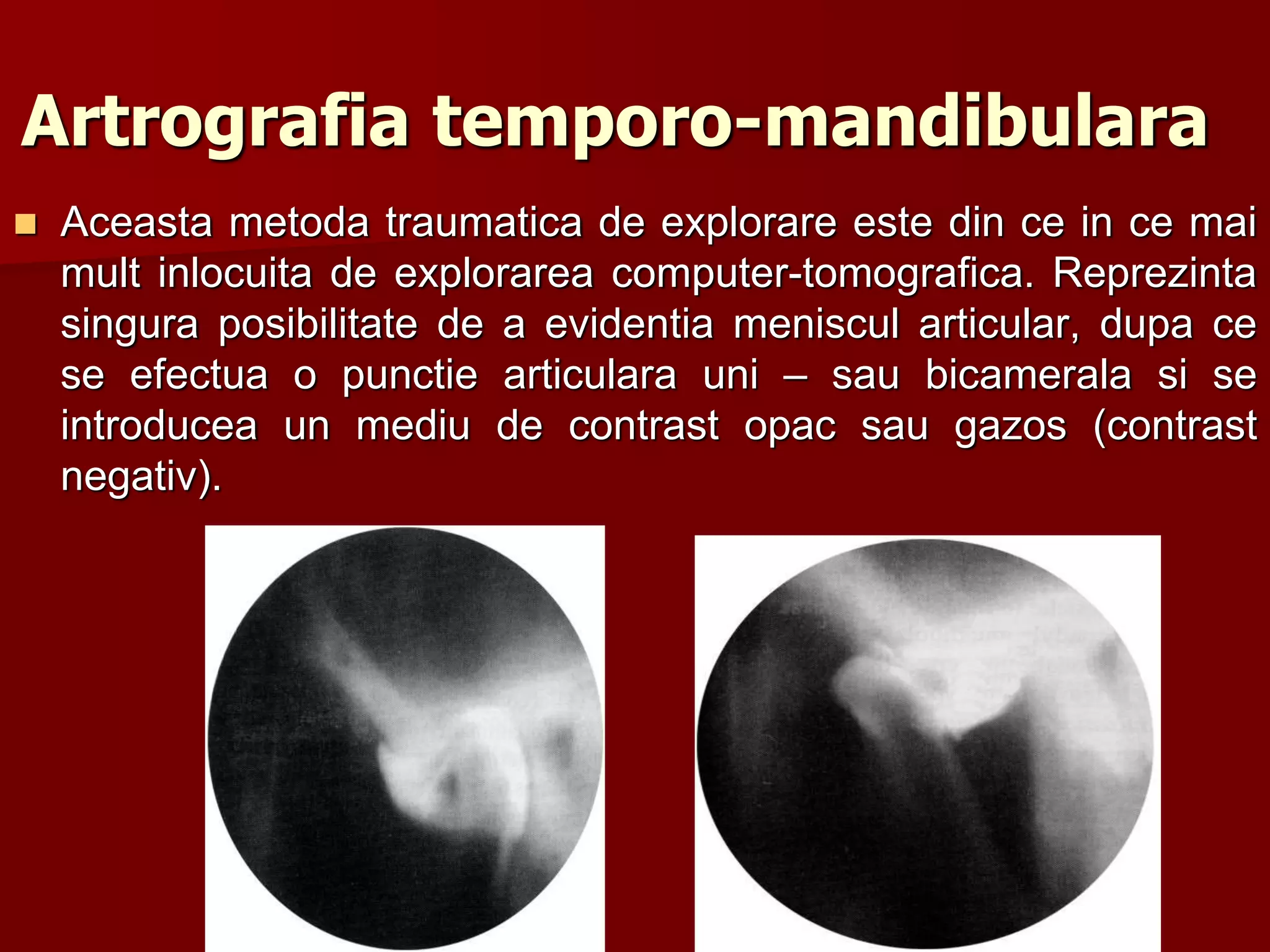 Artrografia temporo-mandibulara
 Aceasta metoda traumatica de explorare este din ce in ce mai
mult inlocuita de explorarea computer-tomografica. Reprezinta
singura posibilitate de a evidentia meniscul articular, dupa ce
se efectua o punctie articulara uni – sau bicamerala si se
introducea un mediu de contrast opac sau gazos (contrast
negativ).
 