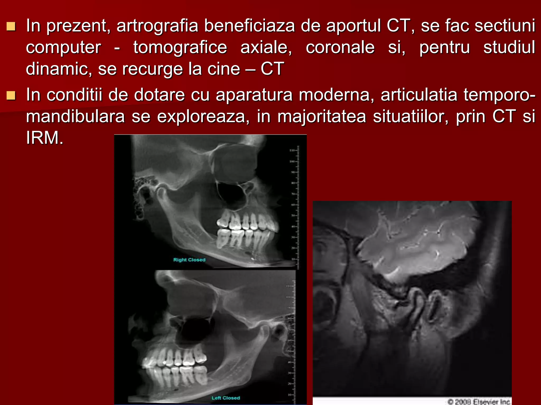  In prezent, artrografia beneficiaza de aportul CT, se fac sectiuni
computer - tomografice axiale, coronale si, pentru studiul
dinamic, se recurge la cine – CT
 In conditii de dotare cu aparatura moderna, articulatia temporo-
mandibulara se exploreaza, in majoritatea situatiilor, prin CT si
IRM.
 