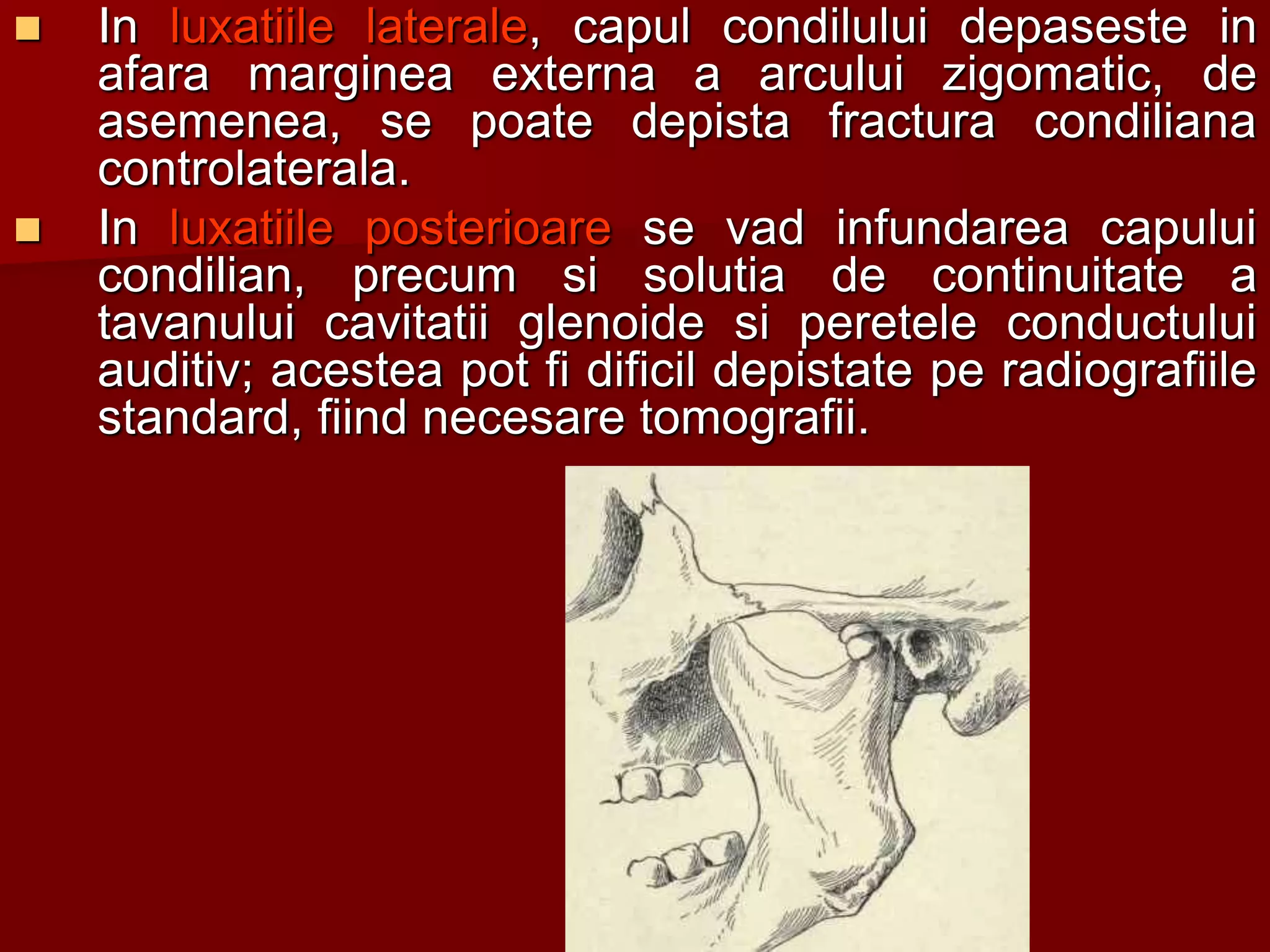  In luxatiile laterale, capul condilului depaseste in
afara marginea externa a arcului zigomatic, de
asemenea, se poate depista fractura condiliana
controlaterala.
 In luxatiile posterioare se vad infundarea capului
condilian, precum si solutia de continuitate a
tavanului cavitatii glenoide si peretele conductului
auditiv; acestea pot fi dificil depistate pe radiografiile
standard, fiind necesare tomografii.
 