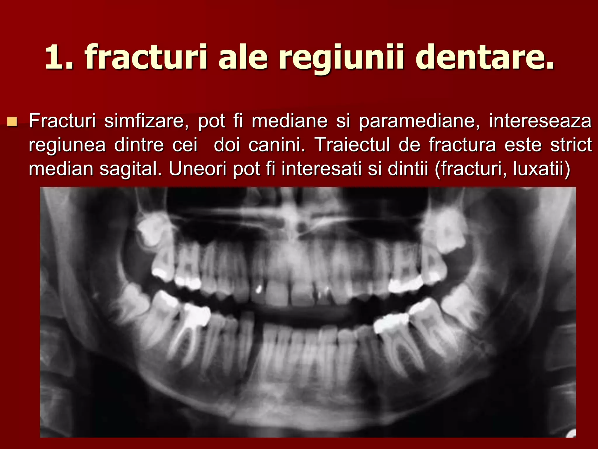 1. fracturi ale regiunii dentare.
 Fracturi simfizare, pot fi mediane si paramediane, intereseaza
regiunea dintre cei doi canini. Traiectul de fractura este strict
median sagital. Uneori pot fi interesati si dintii (fracturi, luxatii)
28
 