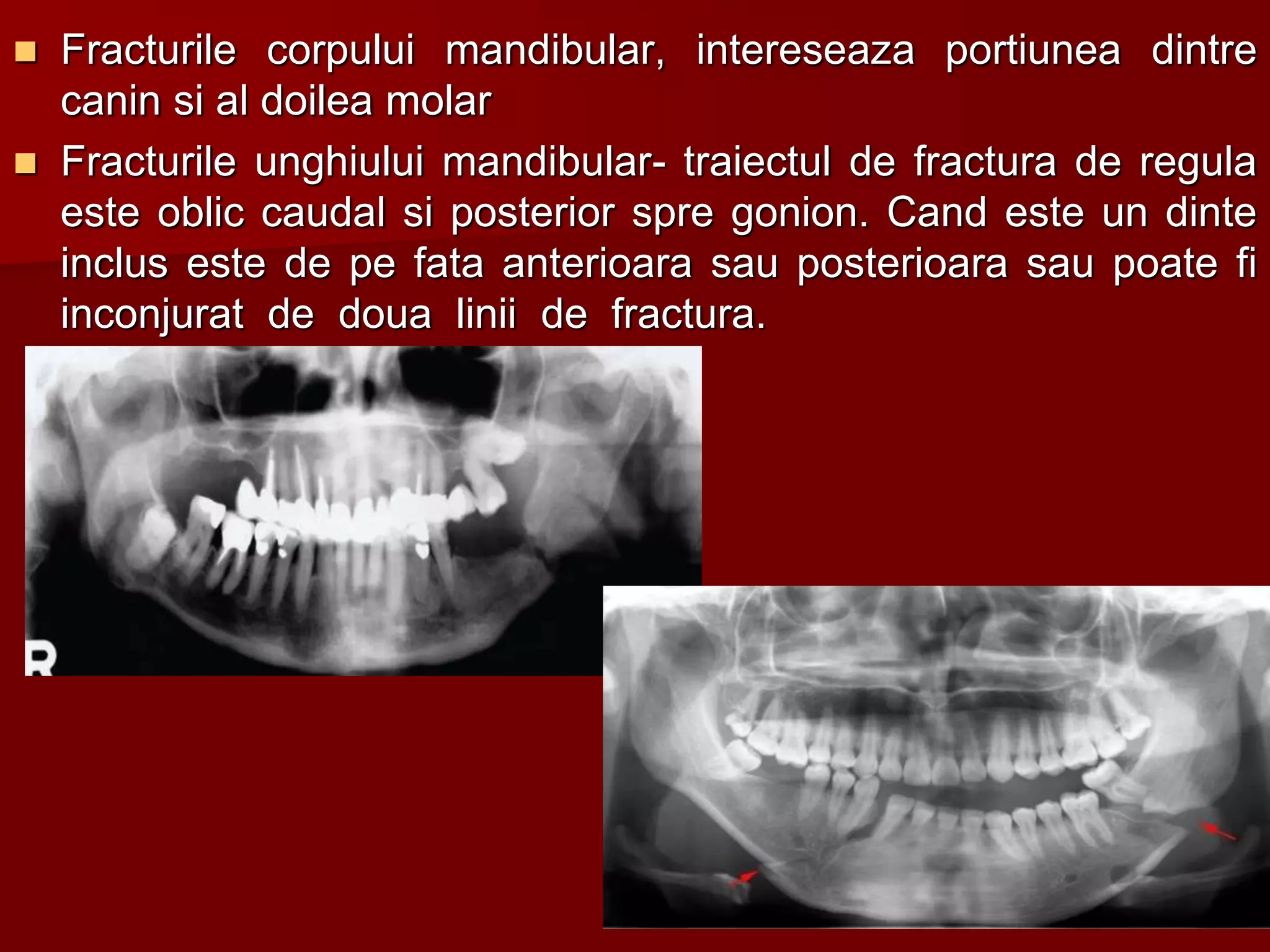  Fracturile corpului mandibular, intereseaza portiunea dintre
canin si al doilea molar
 Fracturile unghiului mandibular- traiectul de fractura de regula
este oblic caudal si posterior spre gonion. Cand este un dinte
inclus este de pe fata anterioara sau posterioara sau poate fi
inconjurat de doua linii de fractura.
29
 