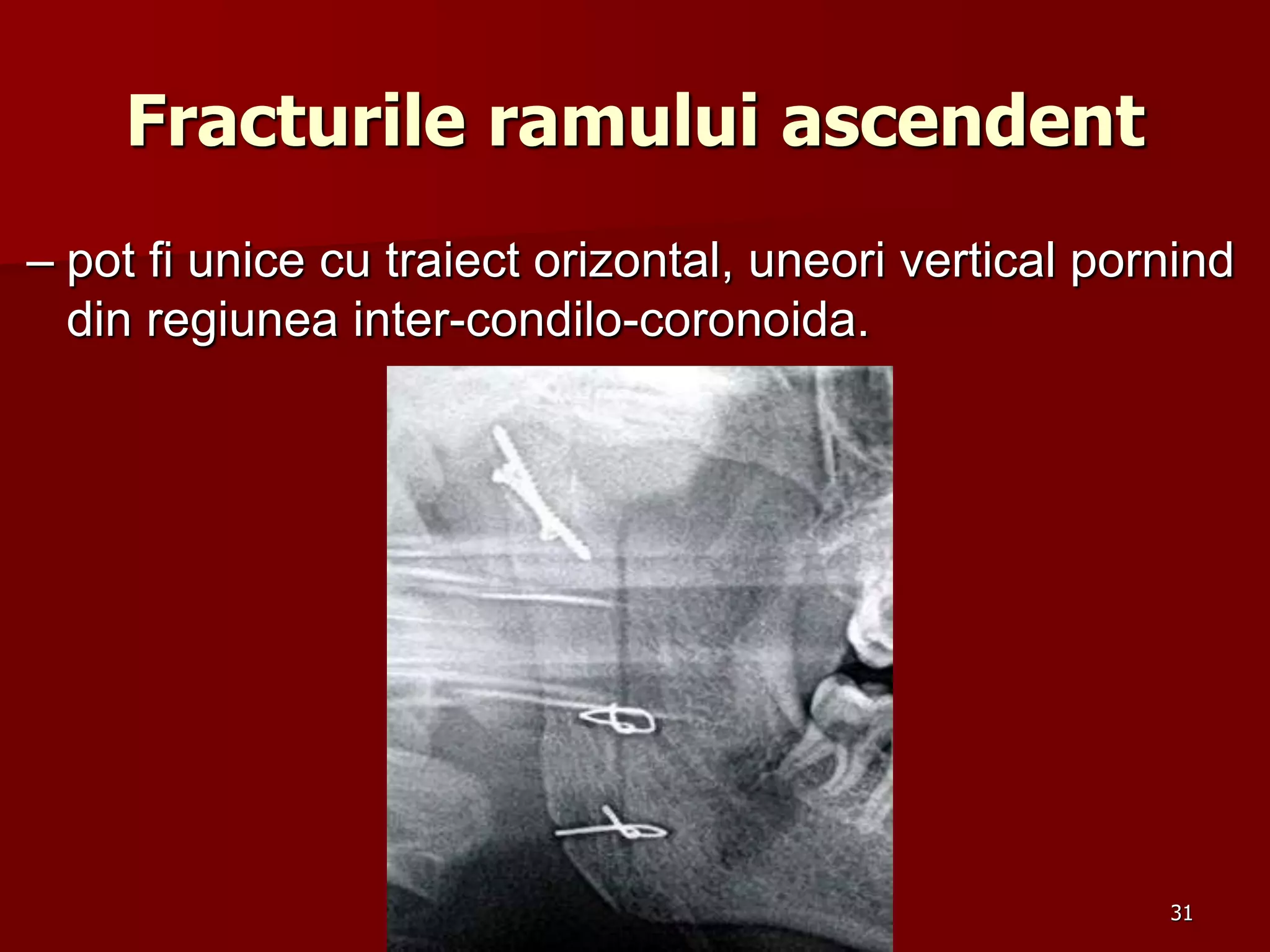 Fracturile ramului ascendent
– pot fi unice cu traiect orizontal, uneori vertical pornind
din regiunea inter-condilo-coronoida.
31
 