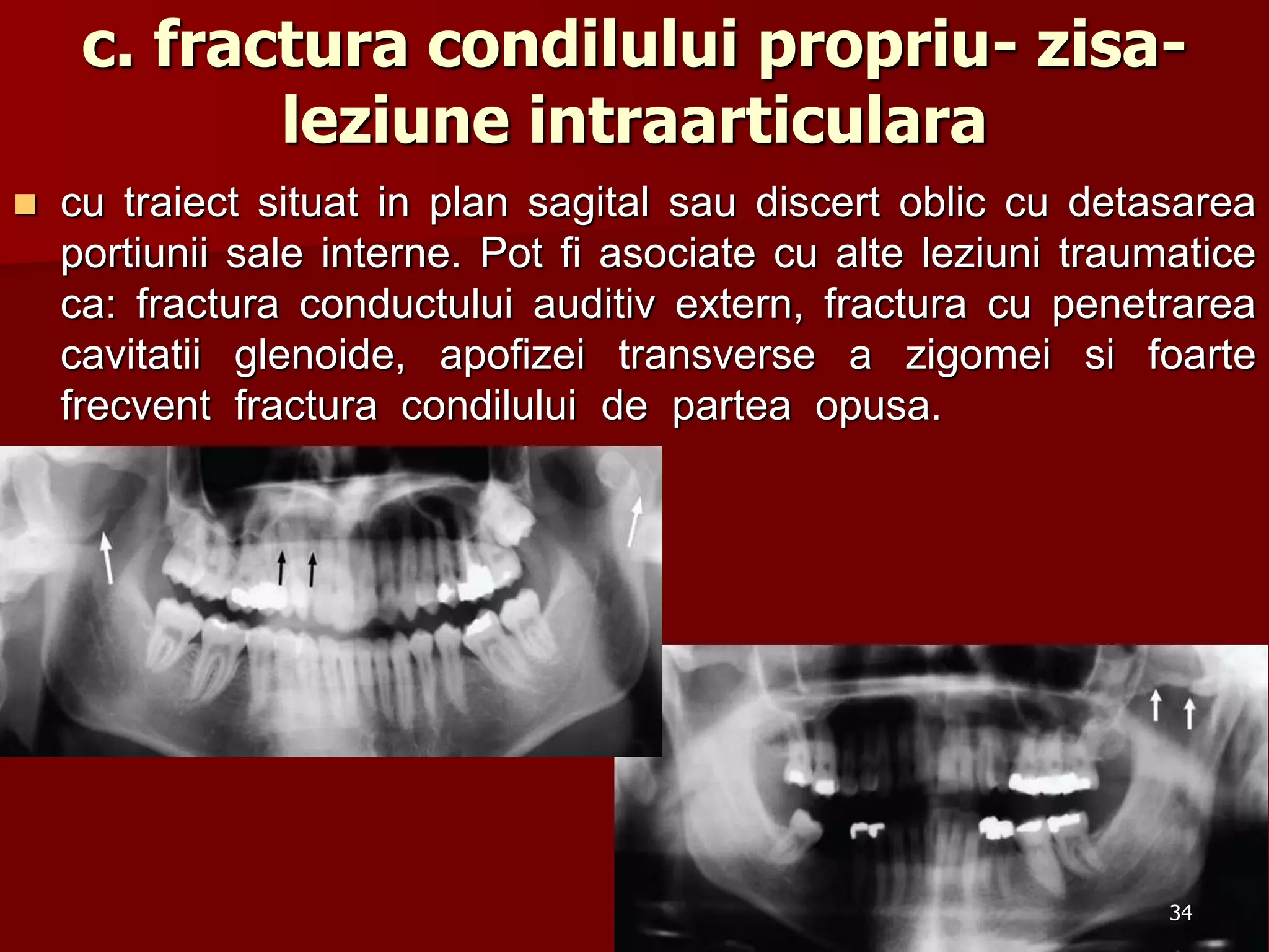 c. fractura condilului propriu- zisa-
leziune intraarticulara
 cu traiect situat in plan sagital sau discert oblic cu detasarea
portiunii sale interne. Pot fi asociate cu alte leziuni traumatice
ca: fractura conductului auditiv extern, fractura cu penetrarea
cavitatii glenoide, apofizei transverse a zigomei si foarte
frecvent fractura condilului de partea opusa.
34
 