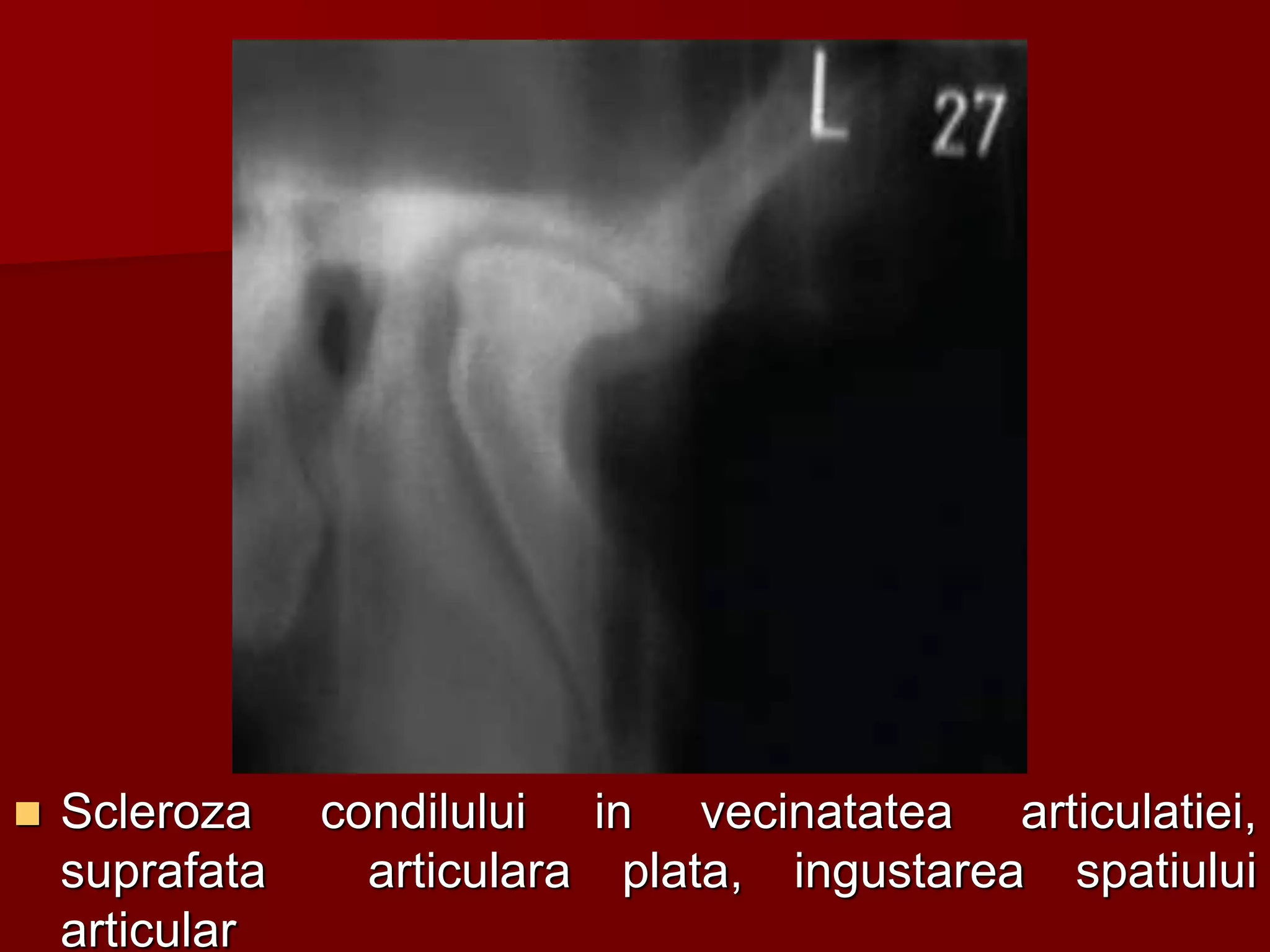 Scleroza condilului in vecinatatea articulatiei,
suprafata articulara plata, ingustarea spatiului
articular
 