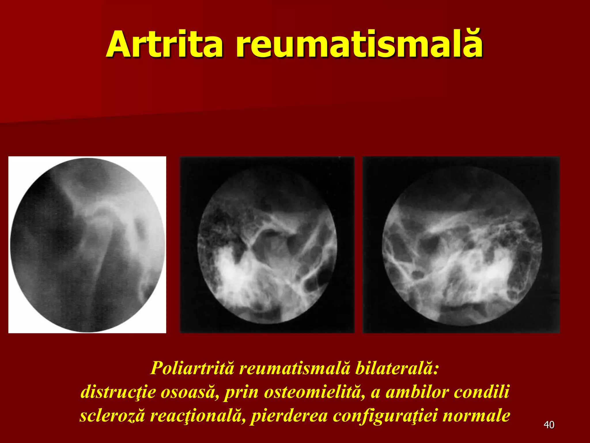 40
Artrita reumatismală
Poliartrită reumatismală bilaterală:
distrucţie osoasă, prin osteomielită, a ambilor condili
scleroză reacţională, pierderea configuraţiei normale
 