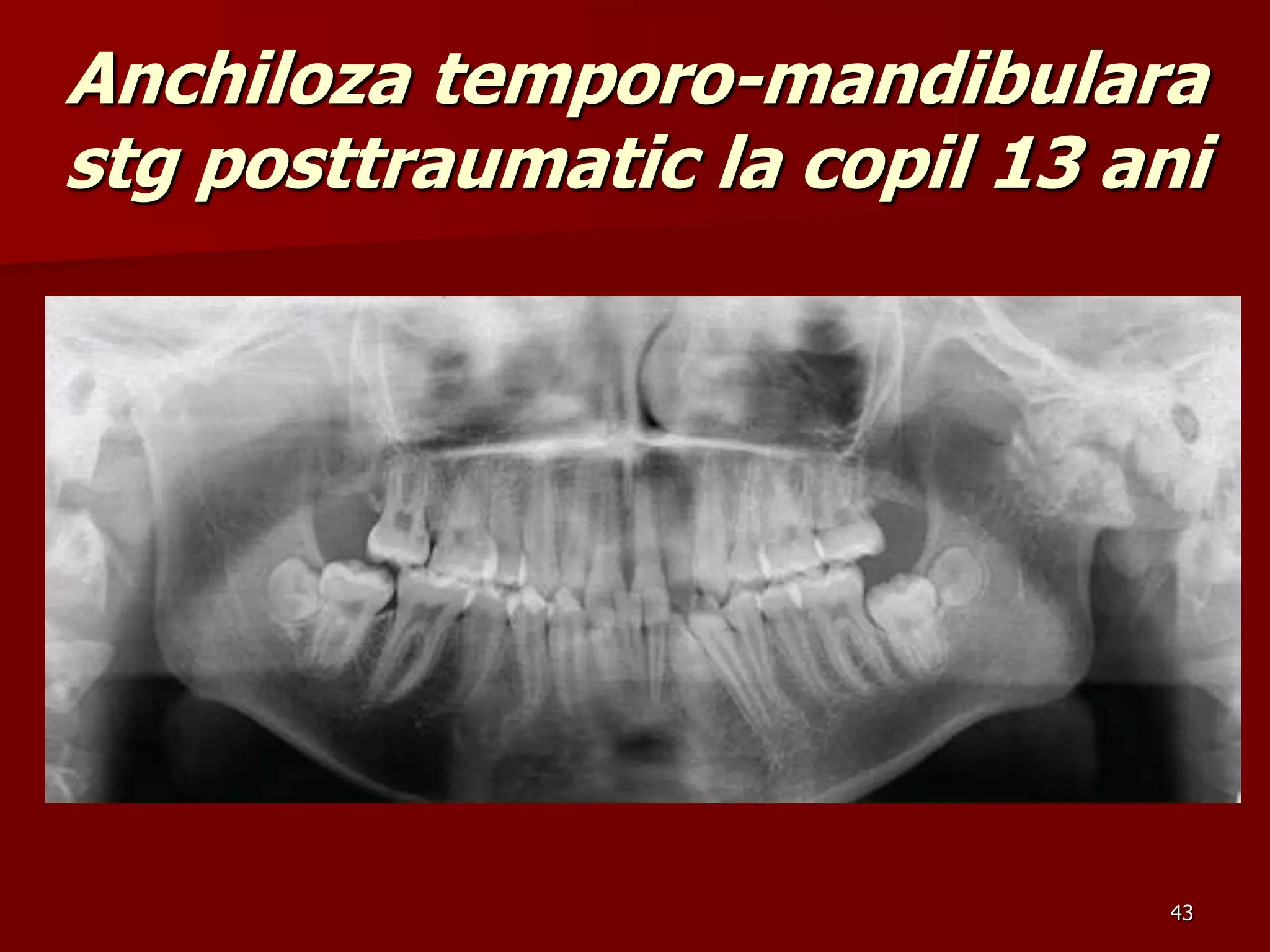 43
Anchiloza temporo-mandibulara
stg posttraumatic la copil 13 ani
 