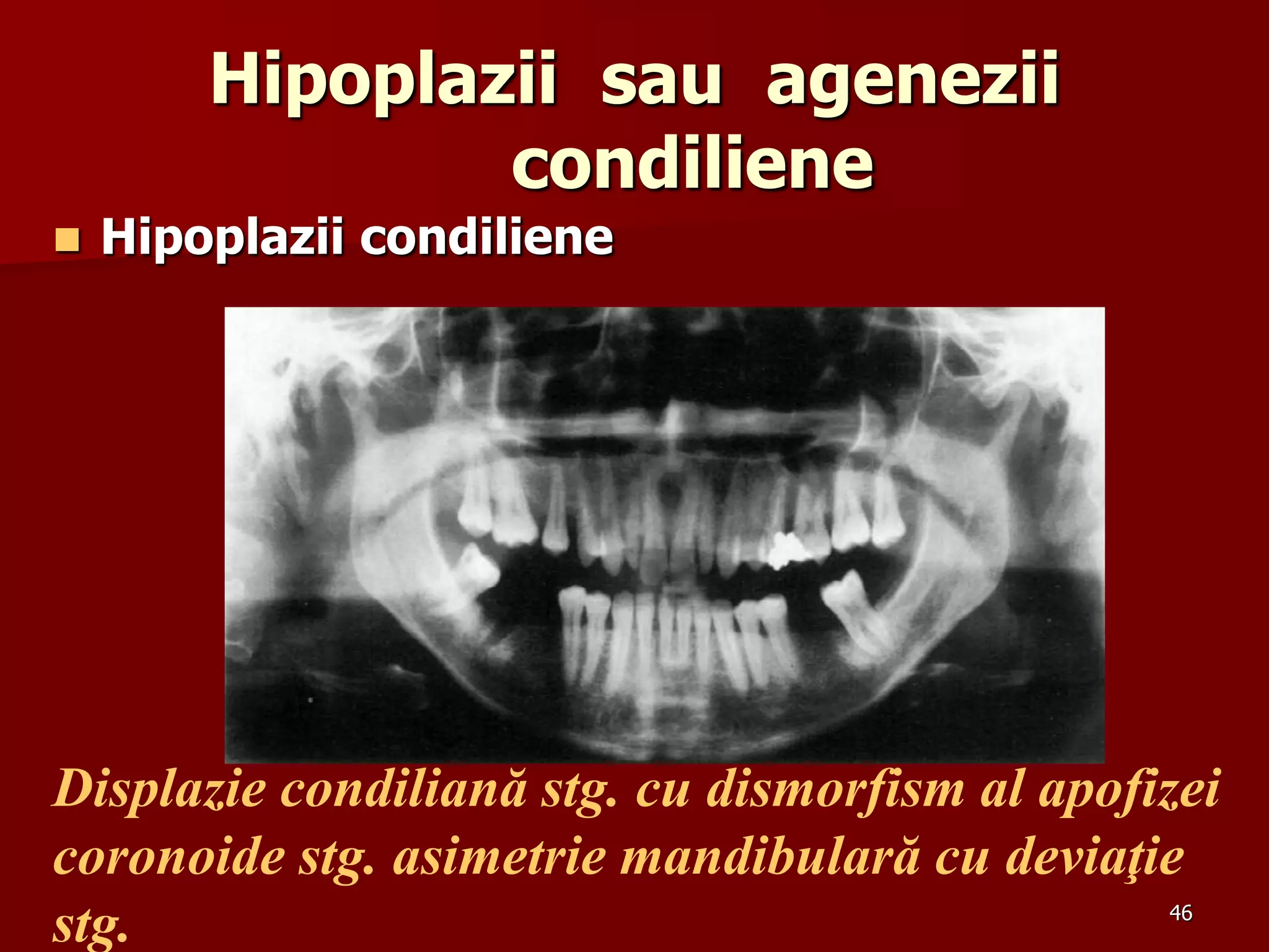 46
Hipoplazii sau agenezii
condiliene
 Hipoplazii condiliene
Displazie condiliană stg. cu dismorfism al apofizei
coronoide stg. asimetrie mandibulară cu deviaţie
stg.
 