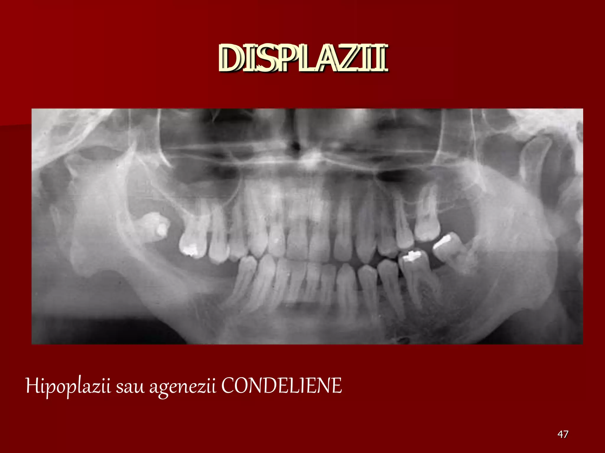 47
DISPLAZII
DISPLAZII
Hipoplazii sau agenezii CONDELIENE
DISPLAZII
 