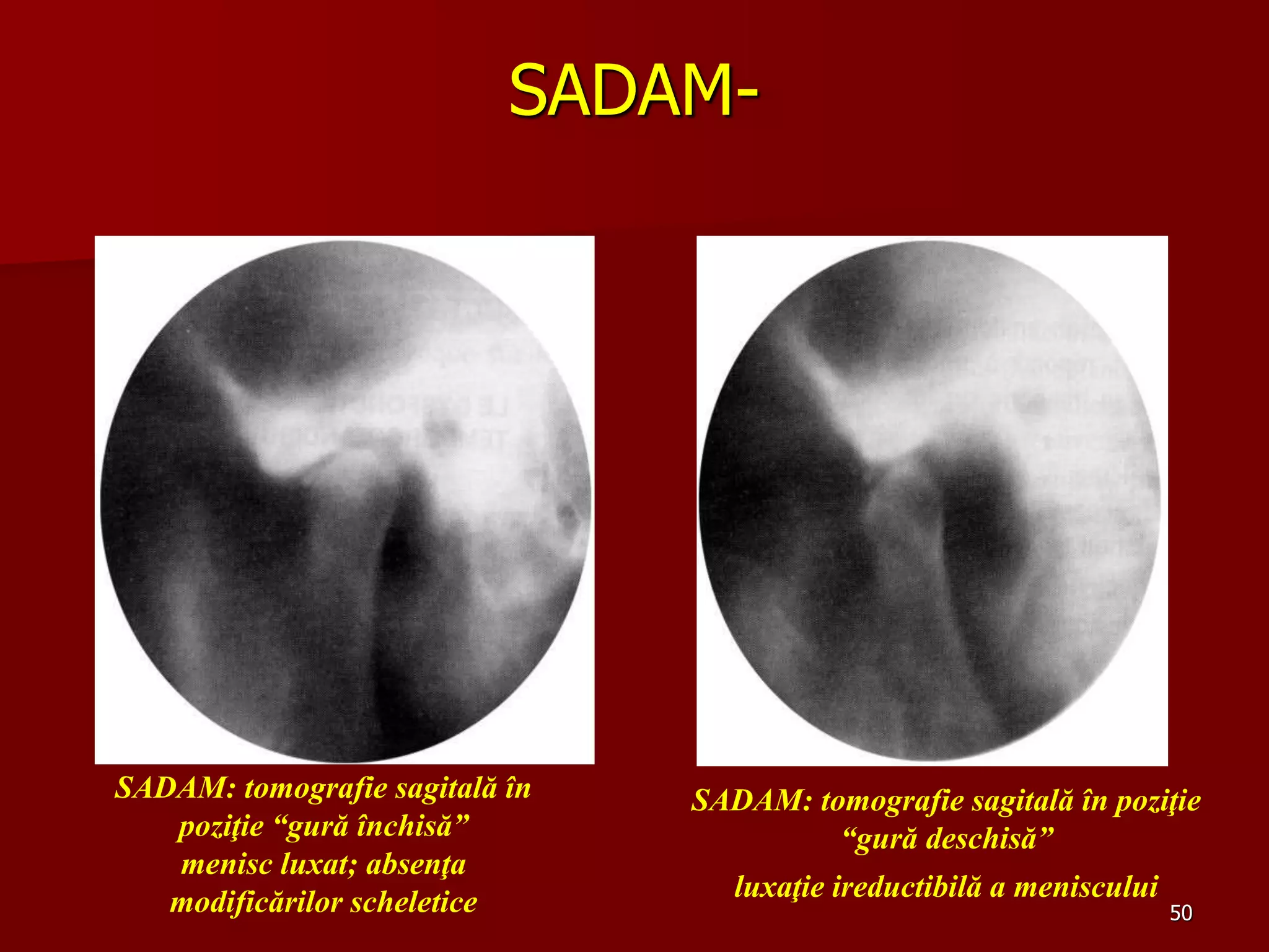 50
SADAM-
SADAM: tomografie sagitală în
poziţie “gură închisă”
menisc luxat; absenţa
modificărilor scheletice
SADAM: tomografie sagitală în poziţie
“gură deschisă”
luxaţie ireductibilă a meniscului
 