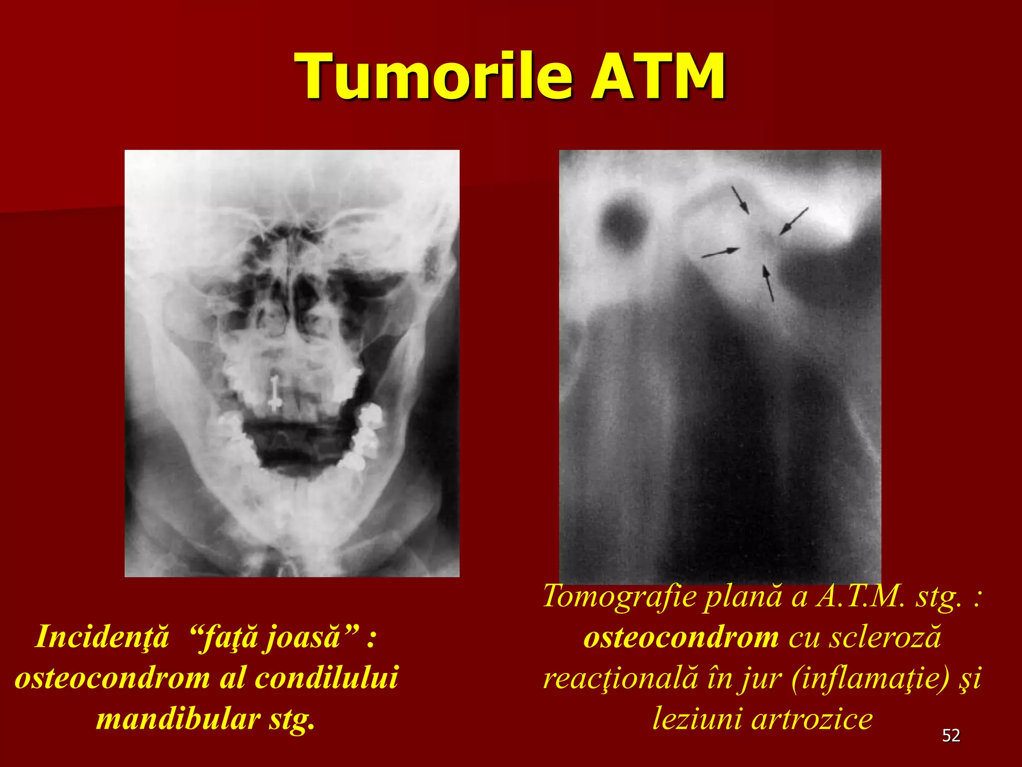 52
Tumorile ATM
Incidenţă “faţă joasă” :
osteocondrom al condilului
mandibular stg.
Tomografie plană a A.T.M. stg. :
osteocondrom cu scleroză
reacţională în jur (inflamaţie) şi
leziuni artrozice
 
