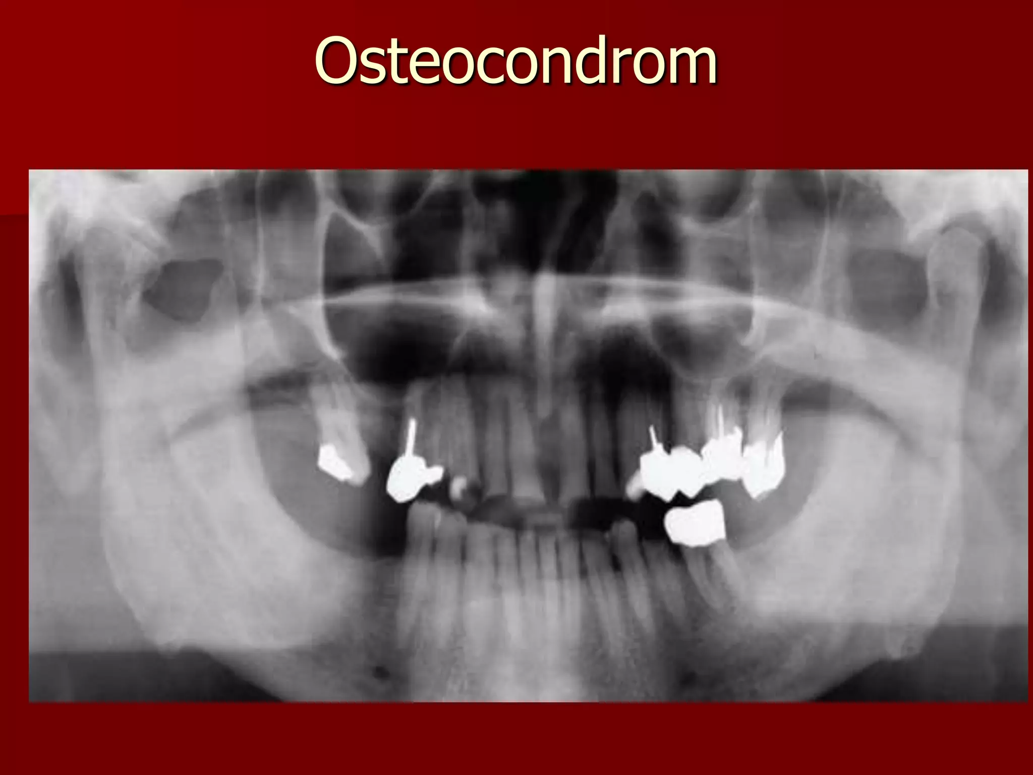 Osteocondrom
 
