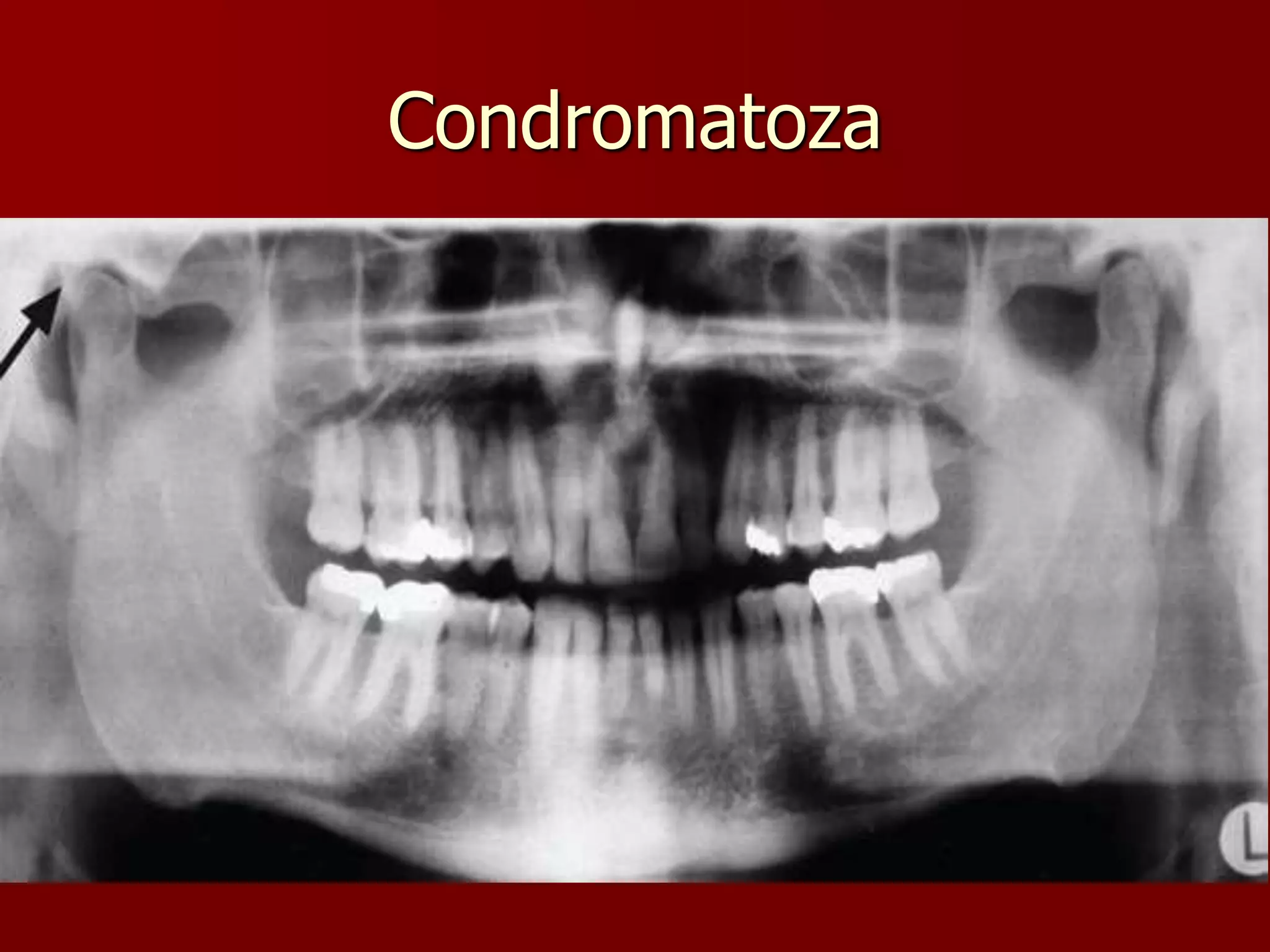Condromatoza
 