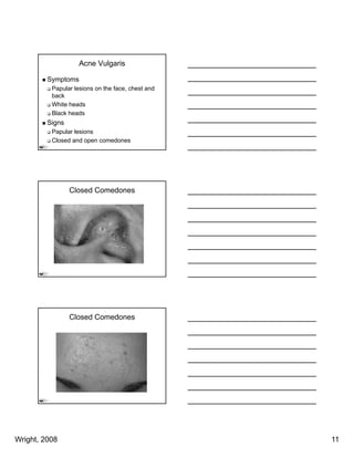 Acne Vulgaris

         Symptoms
          Papular lesions on the face, chest and
          back
          White heads
          Whi h d
          Black heads
         Signs
          Papular lesions
          Closed and open comedones




                 Closed Comedones




                 Closed Comedones




Wright, 2008                                       11
 