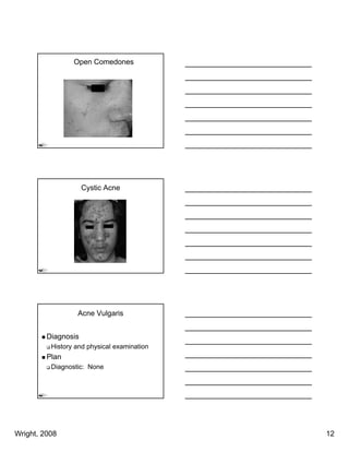 Open Comedones




                     Cystic Acne




                  Acne Vulgaris


         Diagnosis
          History and physical examination
         Plan
          Diagnostic: None




Wright, 2008                                 12
 