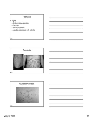 Psoriasis
        Signs
         Erythematous papules
         Plaques
         Nail involvement
         May be associated with arthritis




                       Psoriasis




                  Guttate Psoriasis




Wright, 2008                                15
 