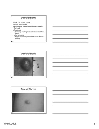Dermatofibroma

          Size: 3 – 10 mm in size
          Color: pink - brown
          Appearance: may appear slightly scaly and
          feel hard
          Treatment:
           Generally – nothing needs to be done about these
           lesions
           Not worrisome
           Biopsy occasionally warranted if unsure of lesion
           etiology




                    Dermatofibroma




                    Dermatofibroma




Wright, 2008                                                   2
 