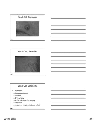 Basal Cell Carcinoma




               Basal Cell Carcinoma




               Basal Cell Carcinoma

          Treatment
           Electrodessication
           Excision
           Cryosurgery
           Mohs’ micrographic surgery
           Radiation
           Imiquimod (superficial basal cells)




Wright, 2008                                     32
 