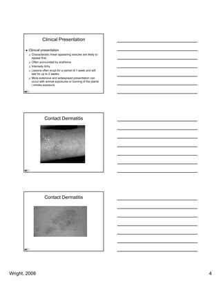 Clinical Presentation

        Clinical presentation
          Characteristic linear appearing vesicles are likely to
          appear first
          Often surrounded by erythema
                              y y
          Intensely itchy
          Lesions often erupt for a period of 1 week and will
          last for up to 2 weeks
          More extensive and widespread presentation can
          occur with animal exposures or burning of the plants
          / smoke exposure




                    Contact Dermatitis




                    Contact Dermatitis




Wright, 2008                                                       4
 
